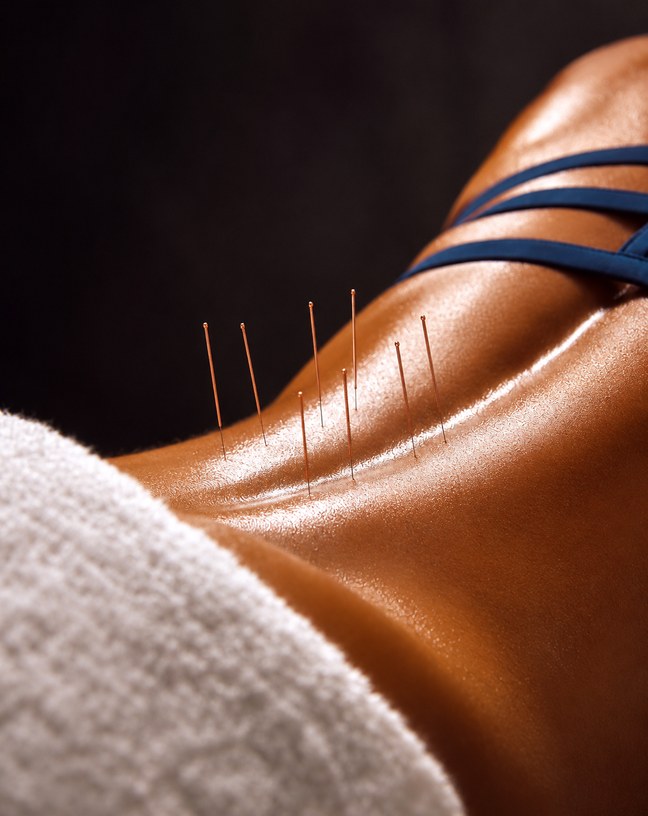 Acupuncture needles along the shoulder and upper back